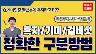 기미인줄 알았는데 흑자라니? 흑자, 기미, 검버섯 ※정확하고 쉬운 구별법※ 나이대별 흑자 생기는 원인