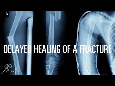 What can cause a fracture to have delayed healing?