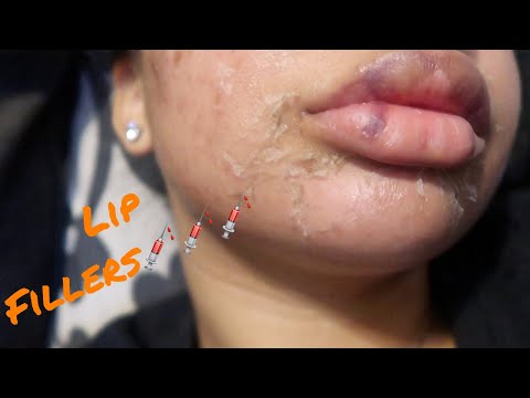 I GOT LIP FILLERS *PROCESS VIDEO*