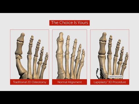 Lapiplasty Bunion Surgery Explained: recovery, success rate and why it's the new gold standard