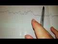 شرح لقراءة تخطيط نبض الجنين CTG