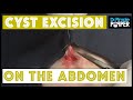 Cyst Excision On The Abdomen