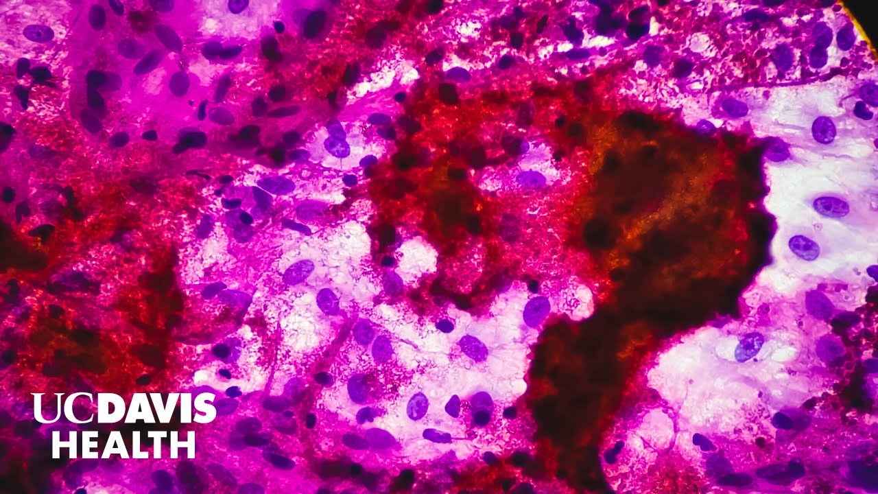 Thumbnail preview of New Blood Test for Tuberculosis Could Transform Global TB Diagnosis | UC Davis Health Research