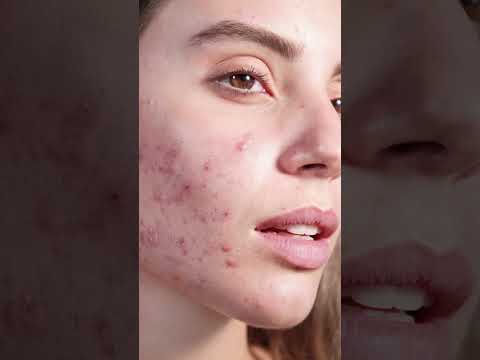 ගැහැණු ශරීරයේ testosterone වැඩී වුණාම ඇතිවෙන සලකුණු