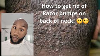 How to get rid of the Razor Bumps on the back of my neck! Itchy bleeding on pillows..Try Kiti Kiti!