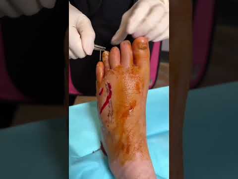 " PIN " Removed From Foot!