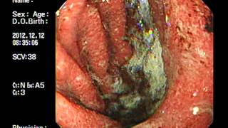 preview picture of video 'viêm dạ dày cấp - Gastric mucosal bleeding'