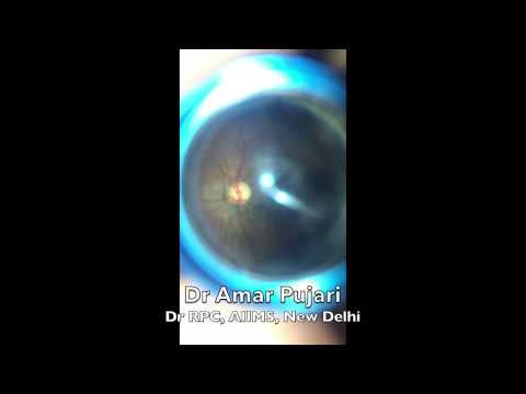 Optic Nerve Head And Posterior Retina Capture Using Smart Phone