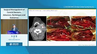 2023년 서울아산병원 <b>뇌졸중</b> 심포지엄 From Basic Principles to Advanced Techniques : Surgical Management of Carotid Stenosis: Advances, Techniques, and Outcomes 미리보기 썸네일