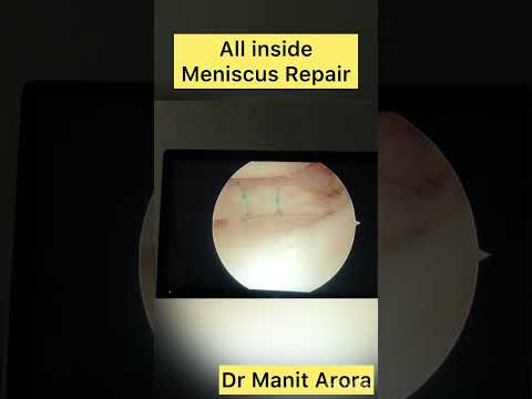 All inside meniscus repair technique - Dr. Manit Arora