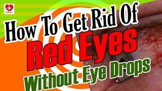 How To Get Rid Of Red Eyes Without Eye Drops: How To Clear Red Eyes Naturally