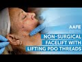 Non-Surgical Facelift with Lifting PDO Threads! | AAFE