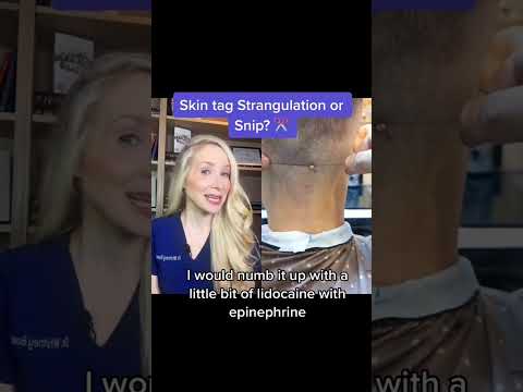 Dermatologist Reacts to Skin Tag Removal #shorts