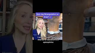Dermatologist Reacts to Skin Tag Removal #shorts