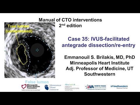 Case 35: Manual of CTO Interventions - IVUS facilitated ADR