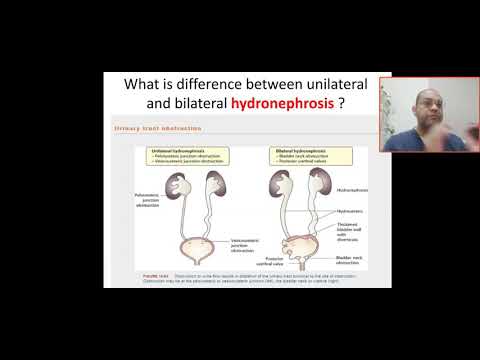 What is the difference between unilateral and bilateral hydronephrosis? PUV, bladder neck obstructio