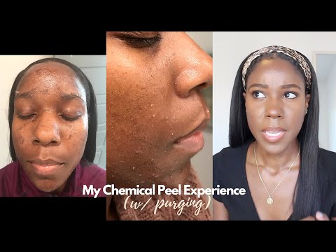 My Chemical Peel Experience (Purging) Before & After | Jamila Nia