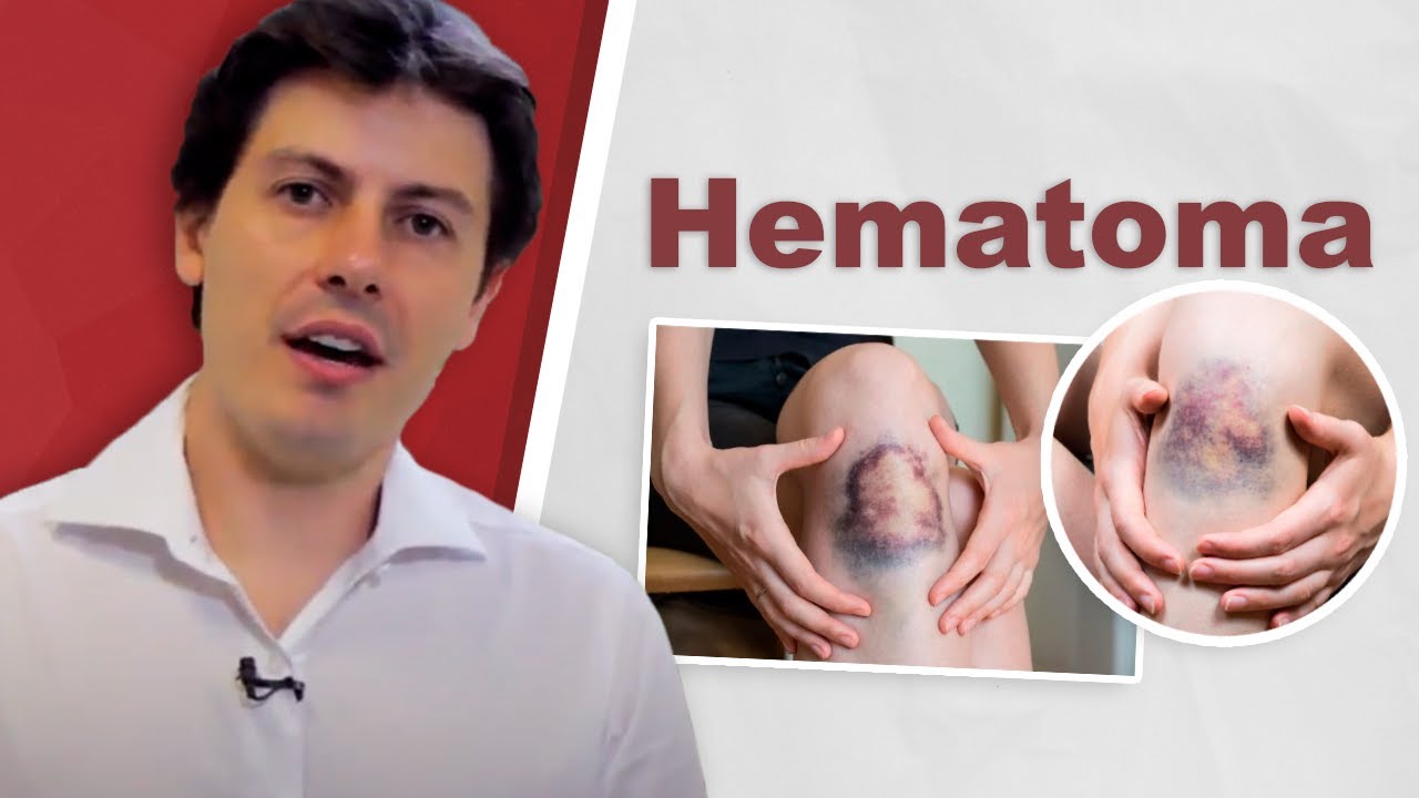 Hematoma: Dr. Fernando Amato