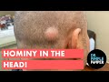 Hominy in the Head! A Pasole Pilar Cyst!