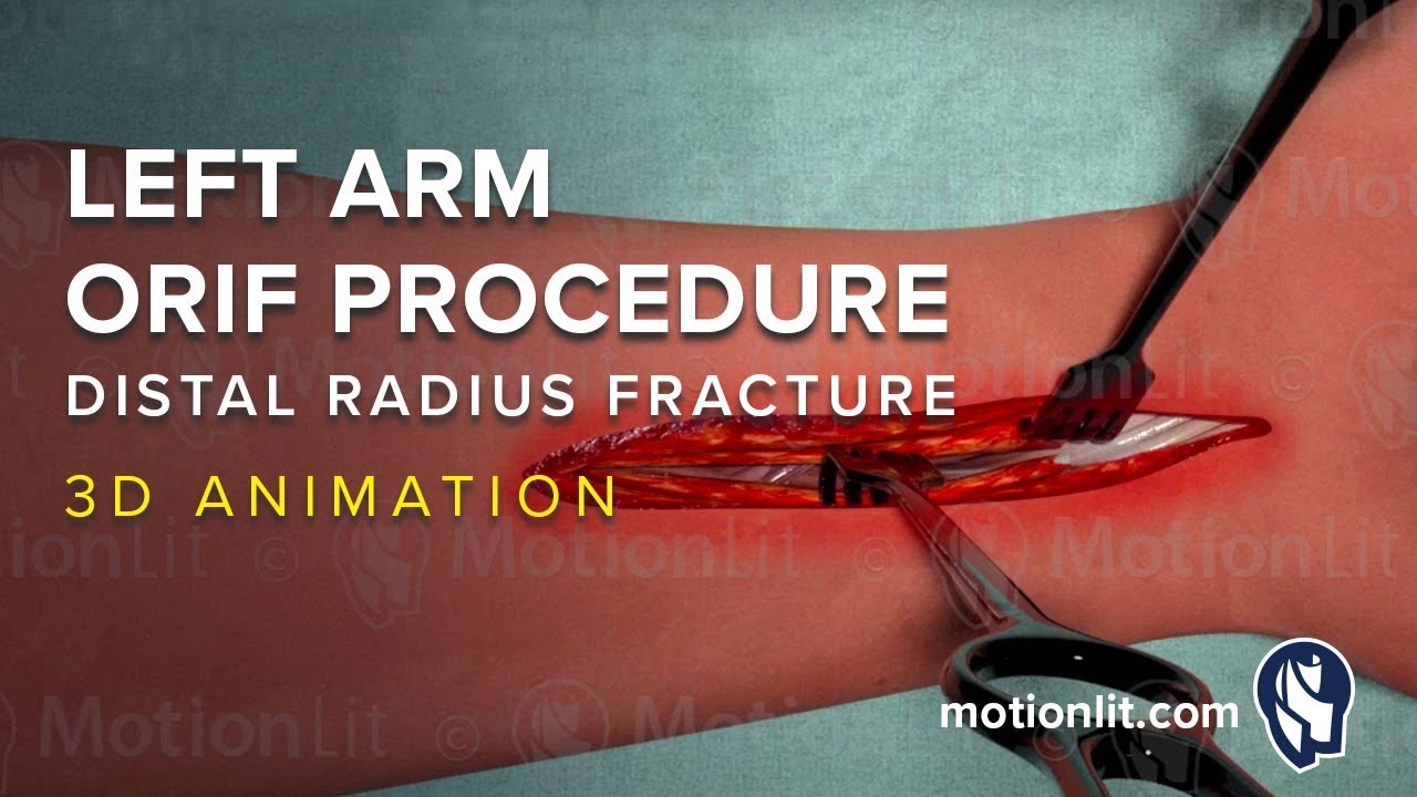 What is ORIF of distal radius? More REF