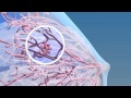 Breast Cancer 3D Medical Animation ABP