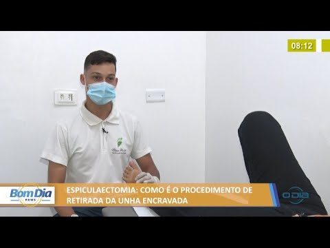 Espiculaectomia, procedimento de retirada da unha encravada 21 06 2021