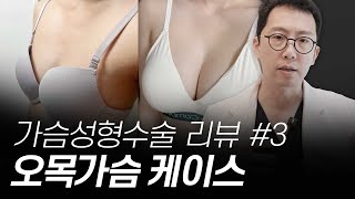 가슴성형 리뷰 Case.03 : 이중평면, 오목가슴