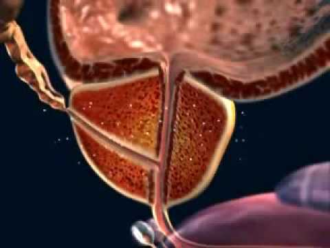 Was ich habe, Prostatitis Prostata als Sex entfernt