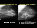 Mammography Normal Vs Abnormal Images BI RADS Classification Breast Cancer Other Diseases