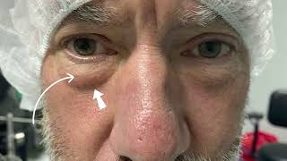 Eyelid surgery in men: treatment for bags under the eyes