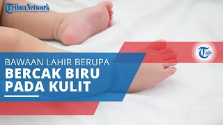 Bercak Mongol, Kondisi Kongenital atau Bawaan dari Lahir Berupa Bercak Kebiruan pada Kulit