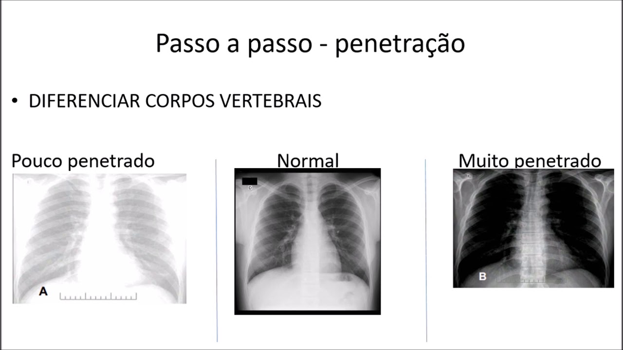 Curso de Radiografia de tórax - Aula I - Analisando radiografia de tórax / Parte 1