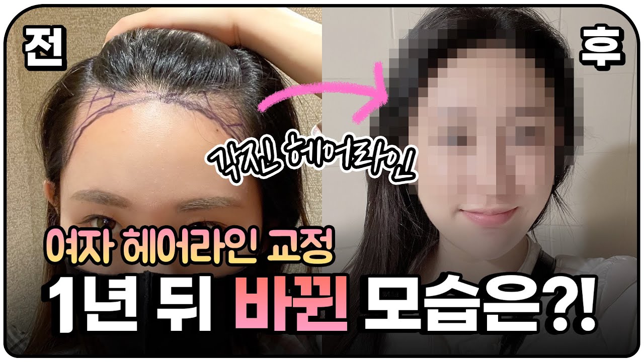 여자헤어라인교정, 1년 후 찐후기ㅣ1200모낭ㅣ뉴헤어