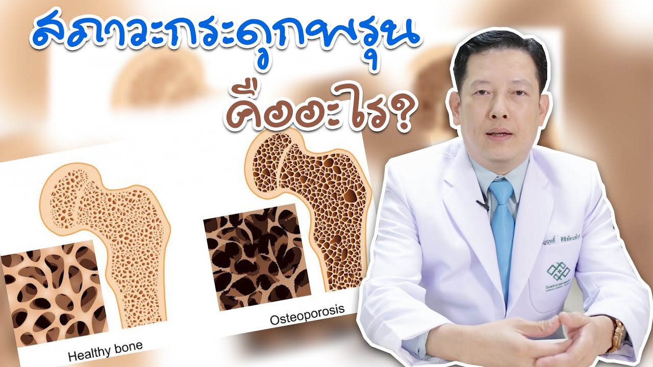 สภาวะกระดูกพรุน คืออะไร?