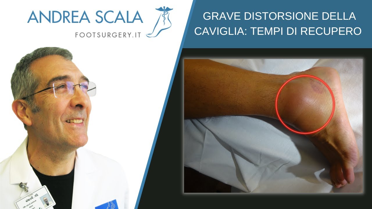 Watch Now Distorsione grave della caviglia | Distorsione della caviglia sintomi e tempi di recupero Distorsione grave della caviglia | Distorsione della caviglia sintomi e tempi di recupero