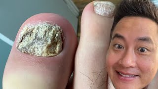 IS THIS A FUNGUS OR PSORIASIS OF THE TOE NAIL?