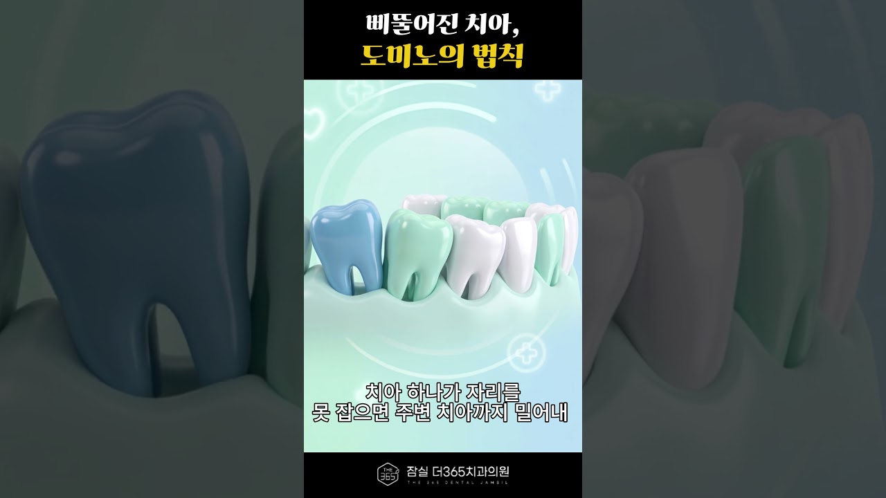 삐뚤어진 치아, 도미노처럼 무너질 수 있습니다