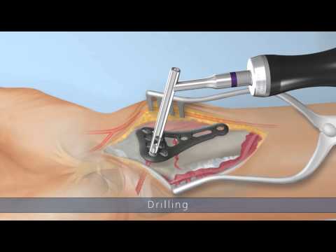 Ixos® Radius plate system P4 Wave – Surgical technique