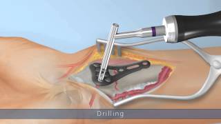 IXOS® | Radius plate system P4 wave | surgical technique