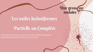 Les môles hydatiformes ( grossesse molaire) expli