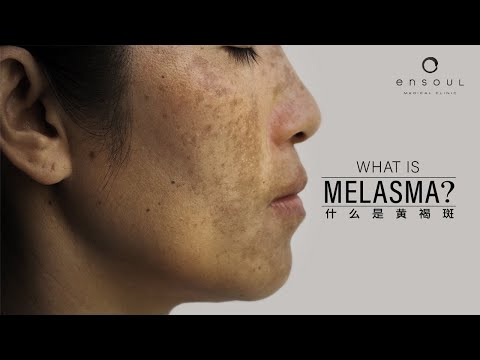 臉有黑斑