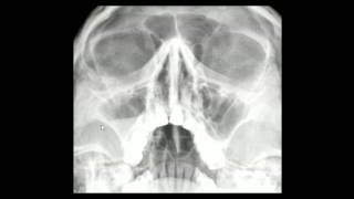 Sinais de sinusite na radiografia dos seios da face