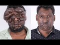 Ravikumar Face Tumor - 1 Year After Surgery