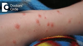 Manifestation and treatment of herpes zoster - Dr. Satish DA