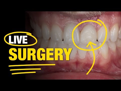 Live-Operation | Extraktion des neunten Zahns mit sofortiger Implantatsetzung und Temporierung