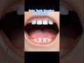 Baby Teeth Eruption Sequence