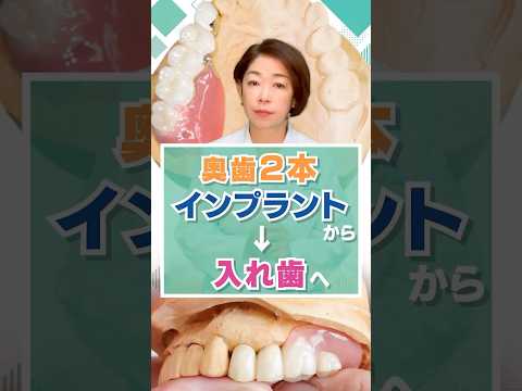 奥歯2本インプラントから入れ歯へ