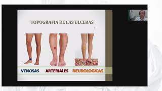 17 Francisco Javier - ¿Cómo Diferenciar las Úlceras Venosas de las Arteriales