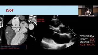 Anatomy of the Aortic valve - Fiona Schnitzler