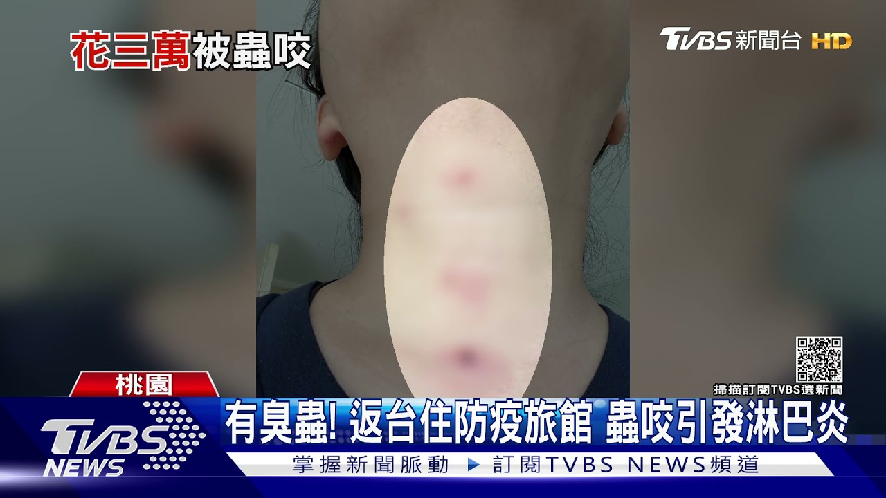 有臭蟲！返台住防疫旅館　蟲咬引發淋巴炎